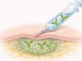Prestige Biopharma IDC Files Patent for Sustained-Release Subcutaneous Delivery Platform for High-Concentration Protein Therape