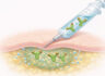 Prestige Biopharma IDC Files Patent for Sustained-Release Subcutaneous Delivery Platform for High-Concentration Protein Therape